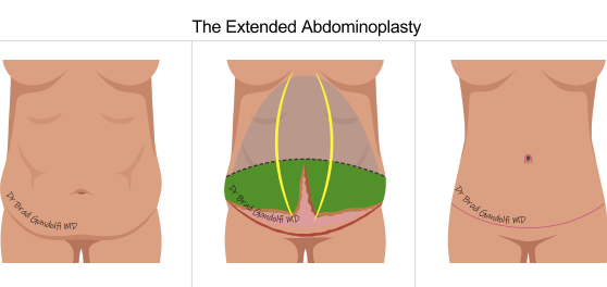 extended abdominoplasty