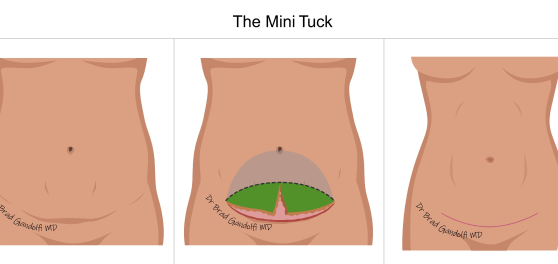 mini tuck