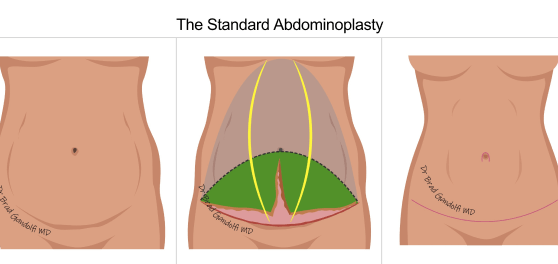 Standard Abdominoplasty