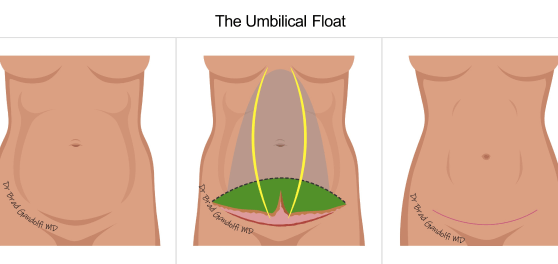 umbilical float